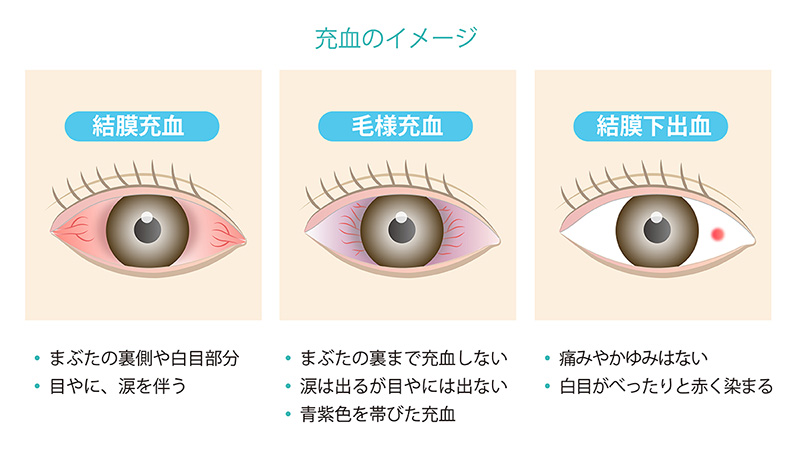 目の症状 病気 よくある症状 新宿コスモ眼科