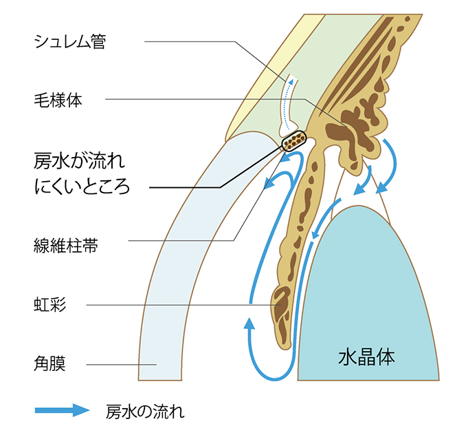 SLT（選択的レーザー線維柱帯形成術）とは